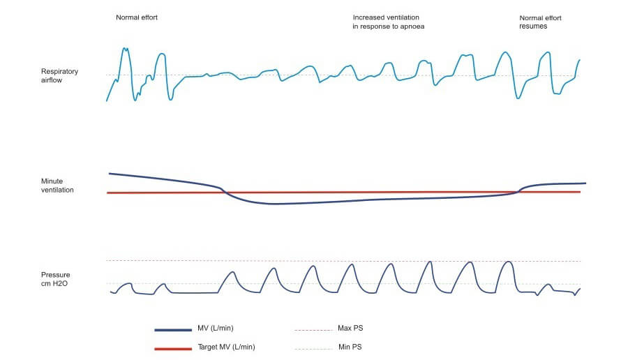 ventilazione minuto-aircurve10csa-pacewave-resmed